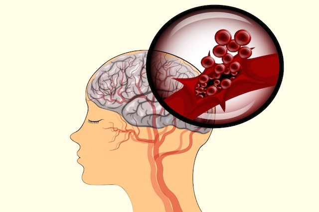 O que é um derrame cerebral e como ele ocorre? - Mundo Inverso
