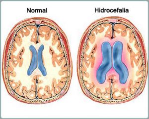 Como a hidrocefalia ocorre em adultos? - Mundo Inverso